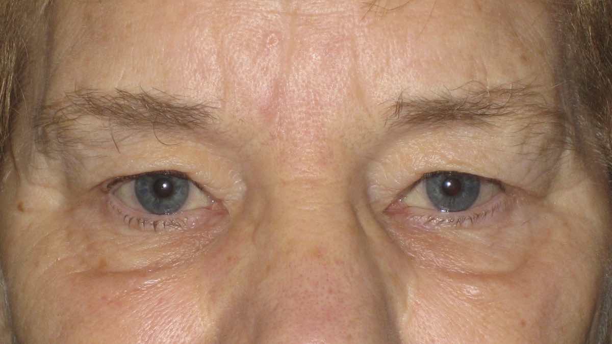 before blepharoplasty and internal browpexy surgery