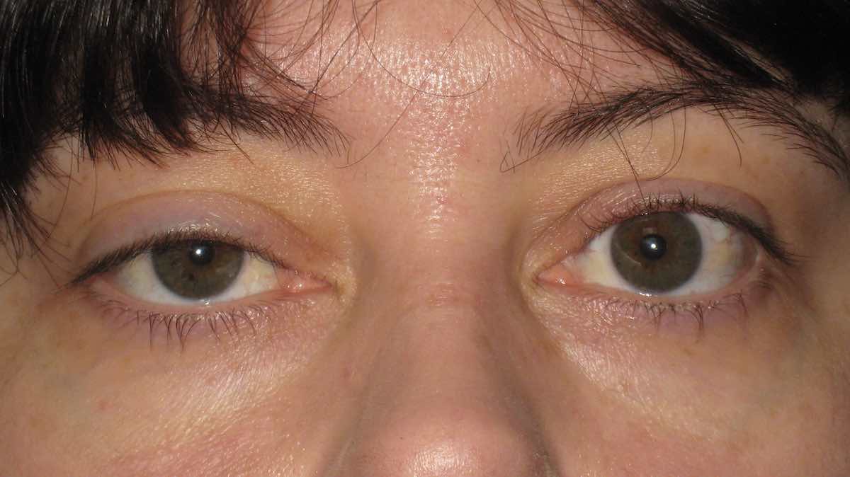 before pictures of drooping eyelid surgery