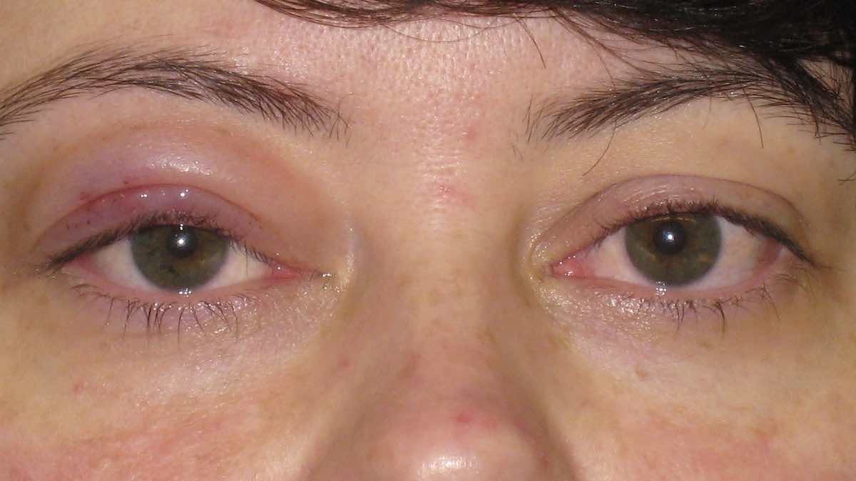swelling following drooping eyelid correction surgery