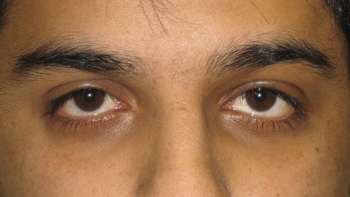 contact lens causing drooping eyelid