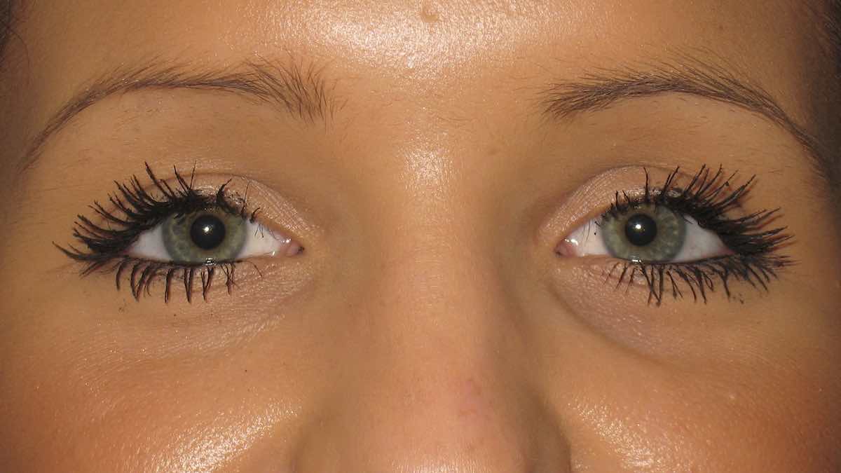 following droopy eyelid surgery