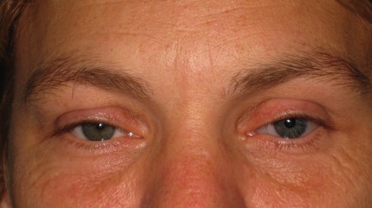 Post Enucleation Socket Syndrome: After treatment with filler injections. Note how this lady