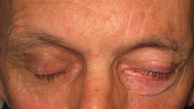 2 months following insertion of a gold weight into the eyelid. This aids closure of the eye. 