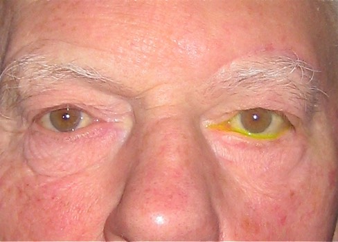 3 months following surgery. Note the scars have started to fade away to look lke normal forehead wrinkle lines.
