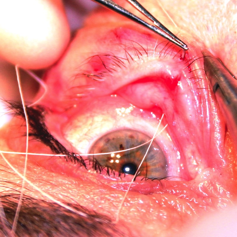 Everting sutures tighten up the lower tendon of the eyelid