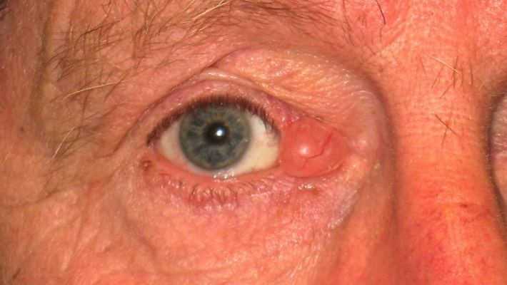 Large cyst of Moll: These represent blockage of the sweat glands. These can enlarge to interfere with function of the eyelid and become quite unsightly