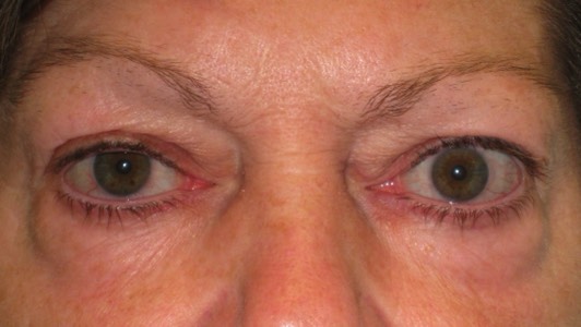 
This lady with burnt out thyroid eye disease complained of a staring appearing to her eye and bulging eyelid bags. She had quite marked bulging of the fat around all 4 eyelids and retraction of her left upper lid- all due to the thyroid eye disease.