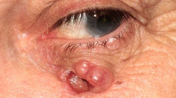 eyelid skin cancers